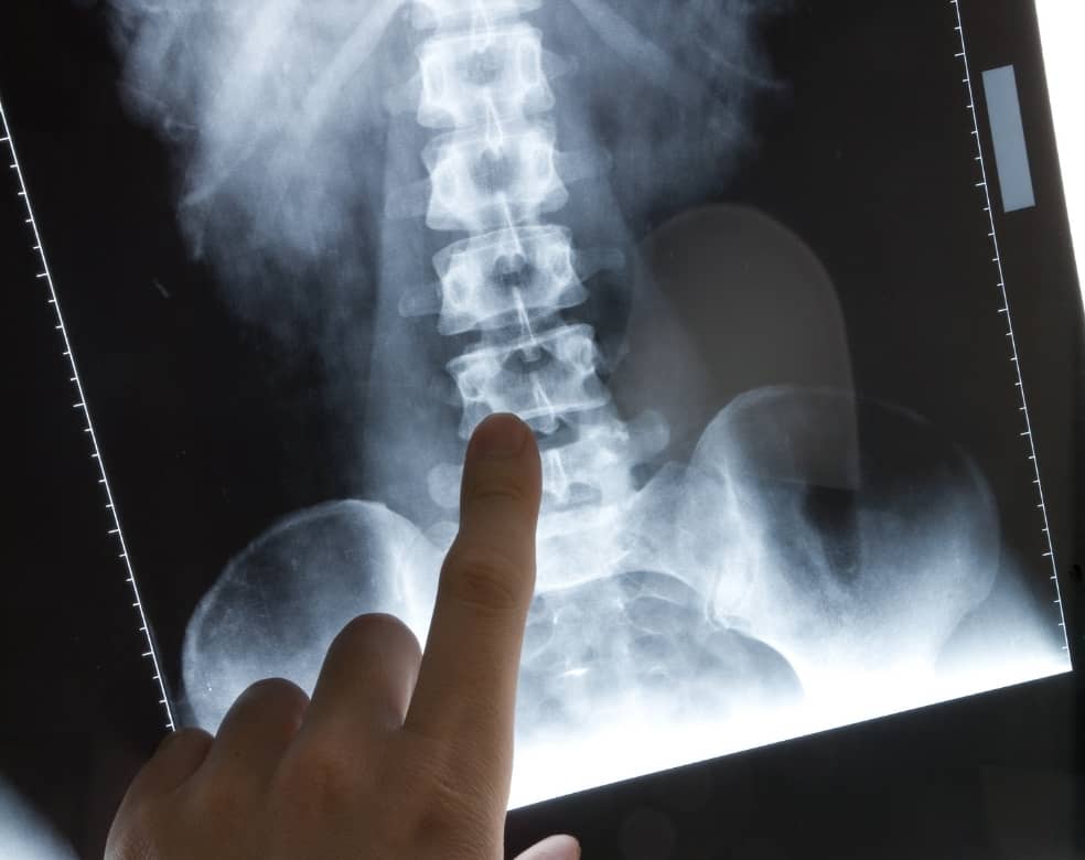 radiografia-de-columna
